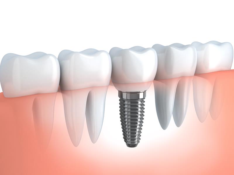 Dental Implants South Yarmouth MA