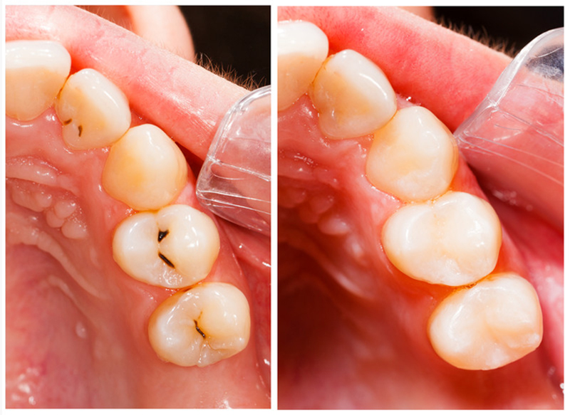 Fillings South Yarmouth MA