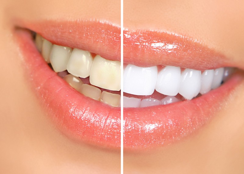 Teeth Whitening South Yarmouth MA