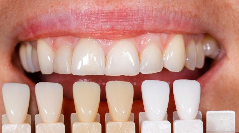 Veneers South Yarmouth MA